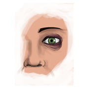 black eye